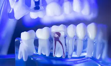 Root Canal Treatment at East Side Dental, Bundaberg