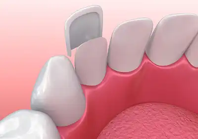 Dental Veneers