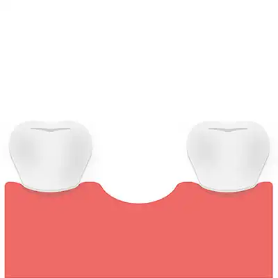 Dental Implant process and procedure