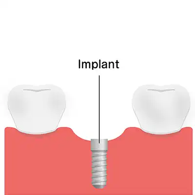 Dental Implant process and procedure