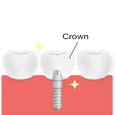 Dental Implant process and procedure