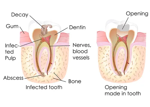 Root Canal Treatment in Bundaberg
