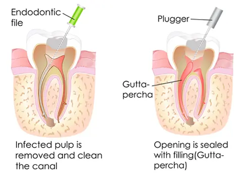 Restore Your Teeth