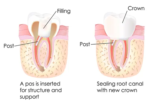 Root Canal Treatment in Bundaberg