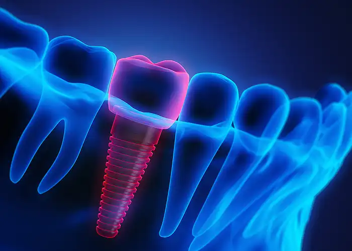 Dental Implants in Bundaberg