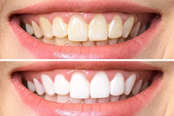 Teeth Whitening Treatment in Bundaberg