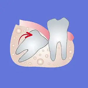 Wisdom Tooth Removal