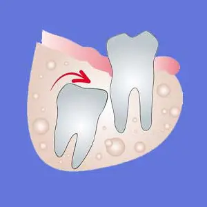 An impacted wisdom tooth