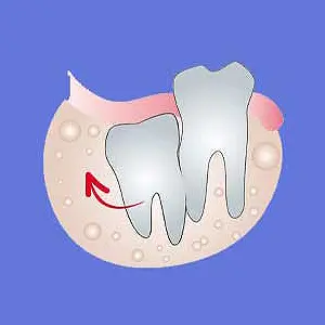 Wisdom Tooth Removal