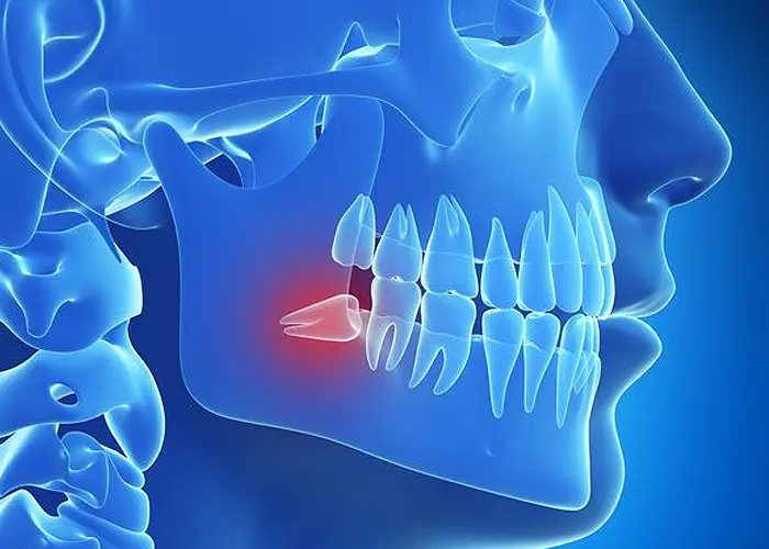 Wisdom Tooth Removal