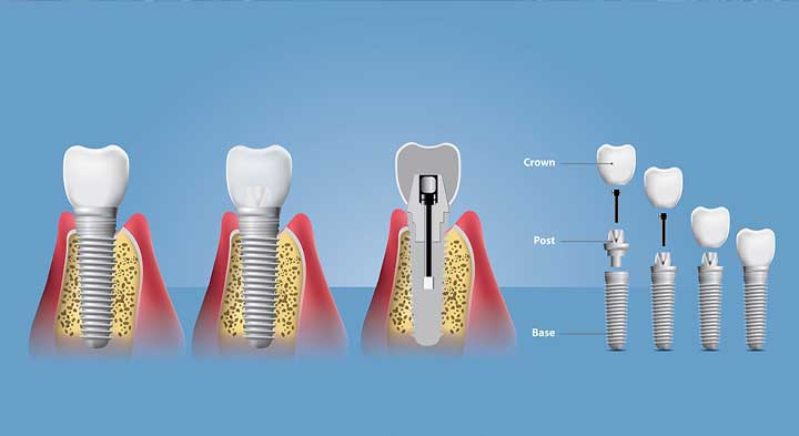 An Overview Of Dental Implants