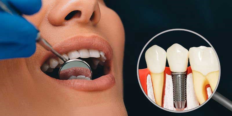 Follow Up Care After Dental Implants