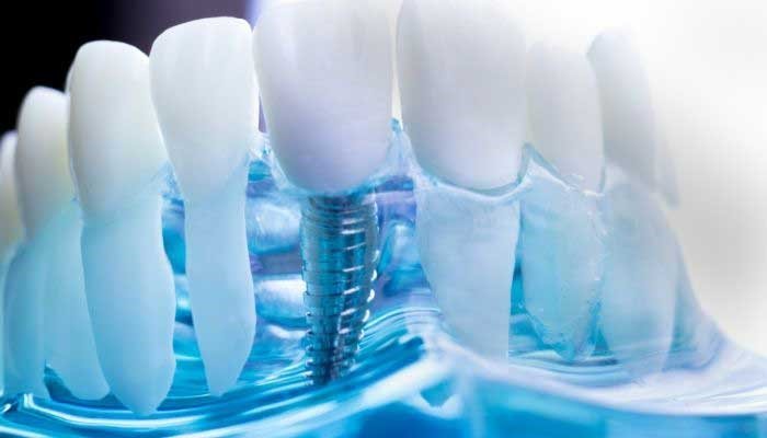 What are dental implants?