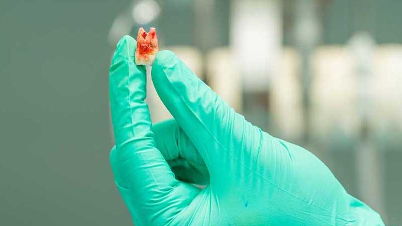 Knocked Out Tooth