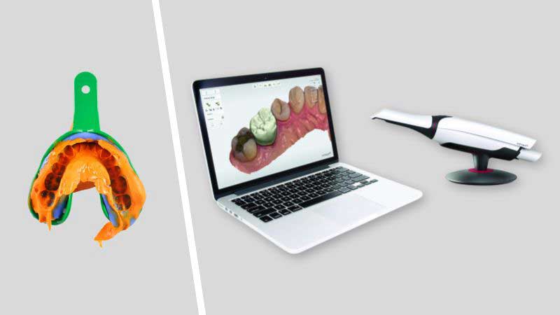 Trios Intraoral Scanner vs Traditional Impressions
